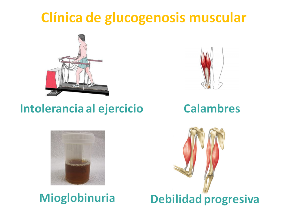 metabolismo de glucogenosis musculares, tipos glucogenosis  origen Metabólica Las y Guía
