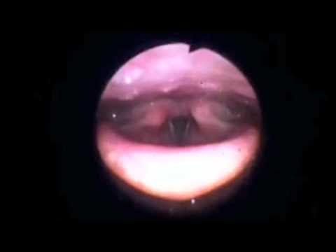 Trouble swallowing after intubation