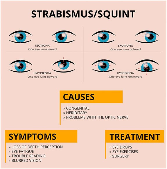 Strabismus Ananthaksha Super Speciality Eye Hospital