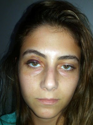 Marcas da agressão deixaram hematoma no rosto de Luciana (Foto: Arquivo pessoal)