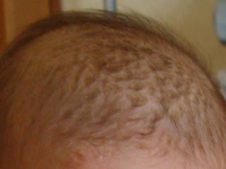 乳児脂漏性湿疹 頭 Amonik Blog