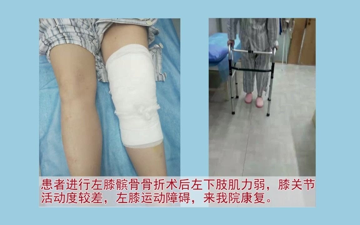 髌骨骨折术后 哔哩哔哩 つロ干杯 Bilibili