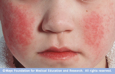 Coronavirus and compromised immune systems: What to know