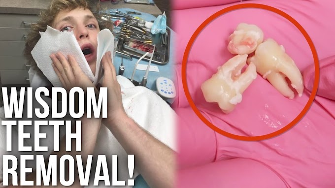 8+ What Age Do You Get Your Wisdom Teeth Removed Ideas