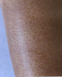 魚鱗病 A 醫學百科