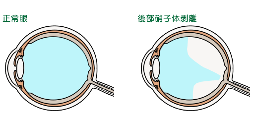 西宮市 ふじもと眼科 目の病気と治療 飛蚊症 ひぶんしょう