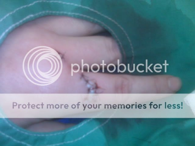 Stiches 1