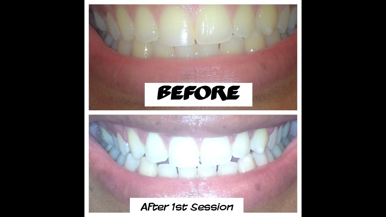 Smile Bright Review| Get White Teeth at Home! - YouTube