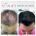 V Care Hair Clinic Treatment Cost