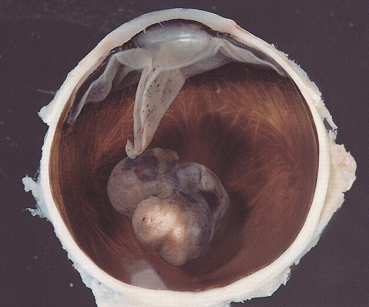 Pathology Outlines - Uvea: uveal melanoma