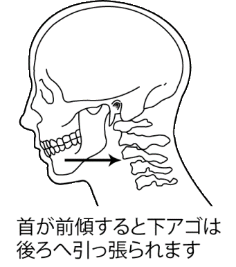肩こりと歯痛の関係