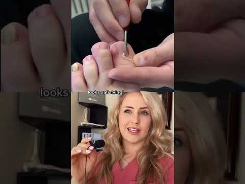 #Doctor reacts: satisfying ingrown removal