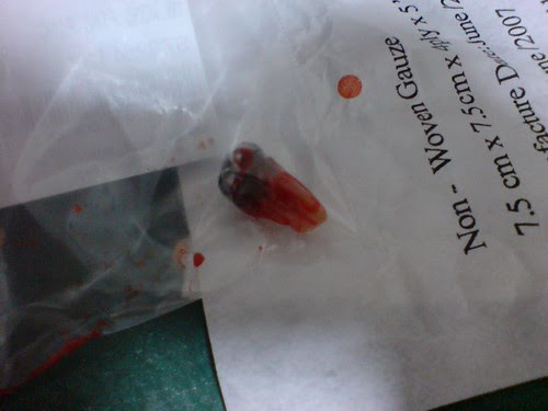 My Extracted Tooth