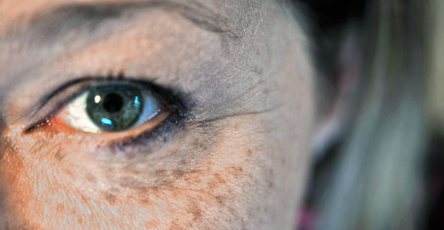 12:365 freckles on one side