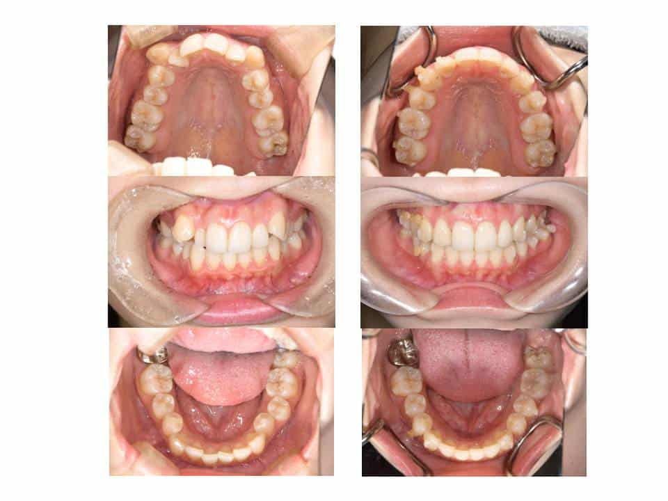 マウスピース矯正治療後の微調整について 神保町タワー歯科 矯正歯科ブログ