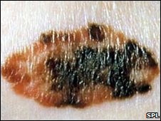 Melanoma