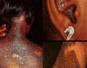 burns from skin bleaching creams