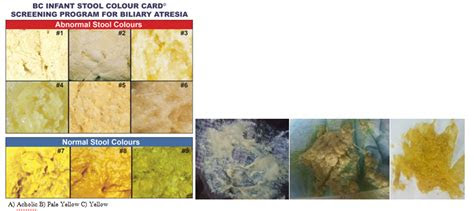 neonatal cholestasis an update medcrave online