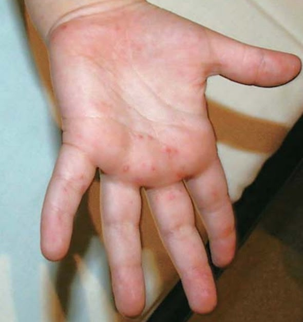 Hand Foot And Mouth Disease What Is Hfmd Thailand Medical News