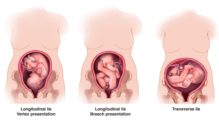 What Is Malpresentation Pregnancy Birth And Baby