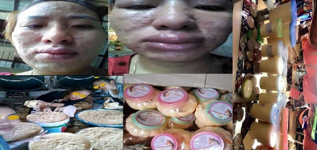Waspadalah!!! Inilah Akibat Sering Memakai KRIM PEMUTIH Wajah! Berikut Adalah Nama-Nama Krim Yang Tidak Boleh Di Pakai!