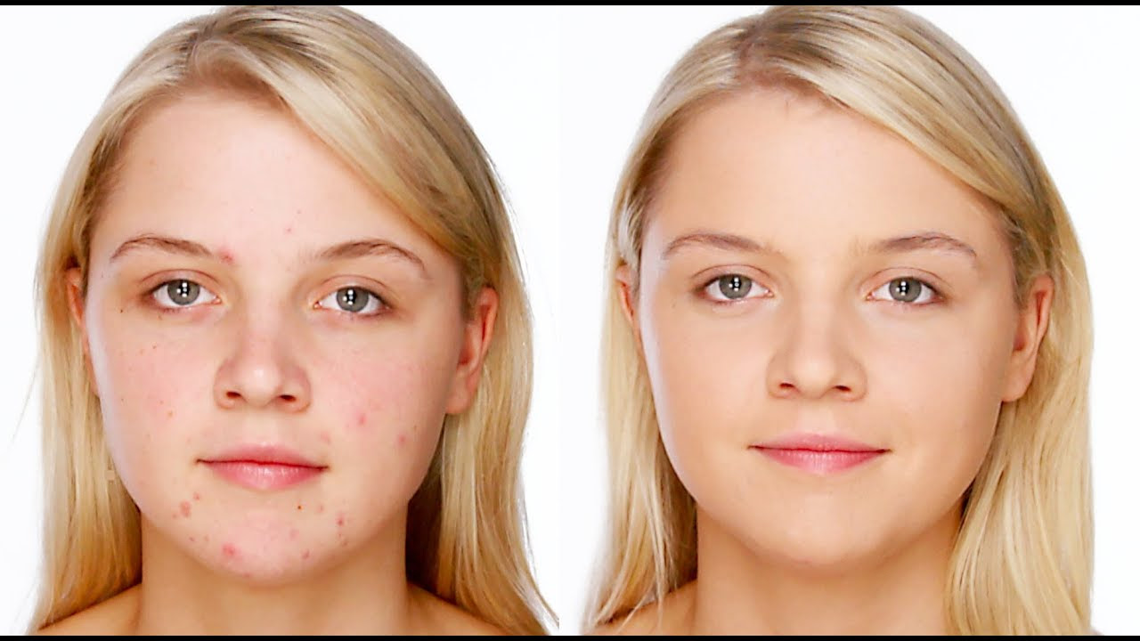 Acne/Blemish Covering Makeup - Foundation & Concealer ...