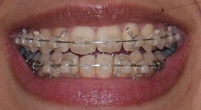 What Are Elastics for Braces? Colgate Oral Care