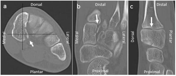 Isolated Nondisplaced Medial Cuneiform Fractures Report Of Two Cases The Foot And Ankle Online Journal