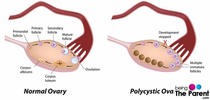 Polycystic Ovary Syndrome-Causes, Symptoms, Diagnosis and ...