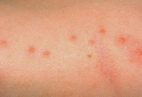 Signs and symptoms of bed bug bites