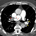 Longembolie X Thorax : Pneumothorax - Wikiwand : Longembolie wordt behandeld met mediations op basis van de oorzaak, symptomen en eventuele complicaties.