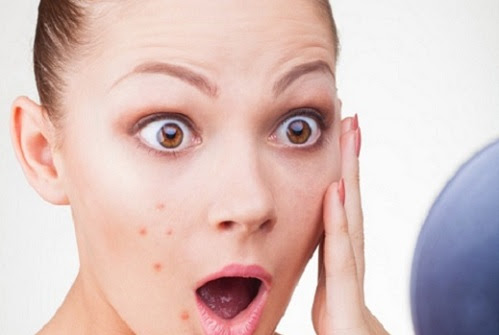 Mụn xuất hiện làm là da trở nên sần sùi mất thẩm mỹ
