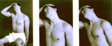 Stretching technique for the scalene (anterior and