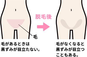 ｉラインやデリケートゾーンの黒ずみが気になる 原因や対処法を解説 Vio脱毛の教室