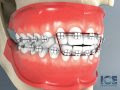 Anterior Openbite Braces