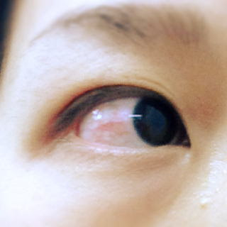 横浜相鉄ビル眼科医院 白目のしみ しろめのしみ 結膜の母斑 けつまくのぼはん 結膜腫瘍 けつまくしゅよう の手術 レーザー治療