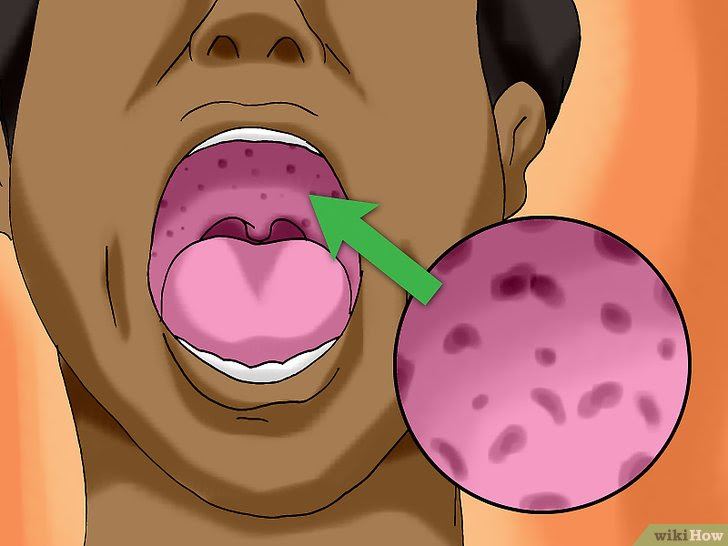 Differentiate Bacterial Tonsillitis and Viral Tonsillitis Step 5 Version 4.jpg