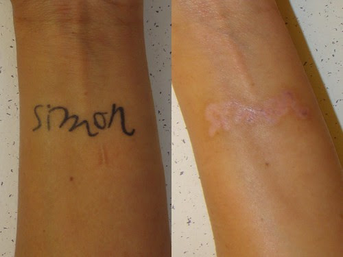 ... latest laser treatments for tattoo removal. | Dr. Joel Schlessinger