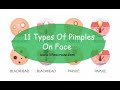 11 Types Of Pimples On Face