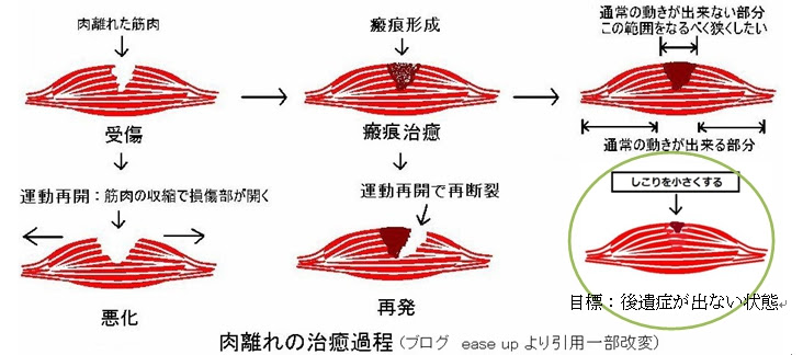 捻挫 肉離れ 茨城県阿見町のあらかわ本郷整骨院
