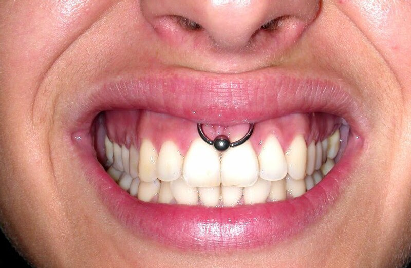 Smiley Piercing