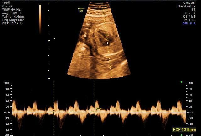 Echographie Des 5 Mois De Grossesse 23 Sa Ou 21 Sg Premiere Grossesse