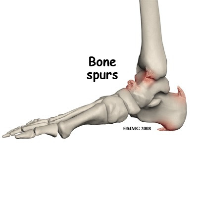 Bone Spur or Osteophyte | Bone and Spine
