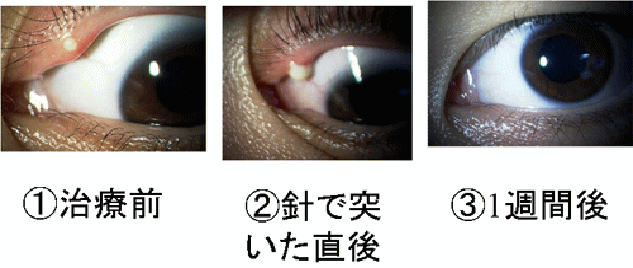 霰粒腫 麦粒腫 ものもらい めばちこ 奈良県 大和郡山市 松本眼科 治療計画