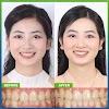 Câu hỏi thường gặp khi niềng răng trong suốt invisalign?