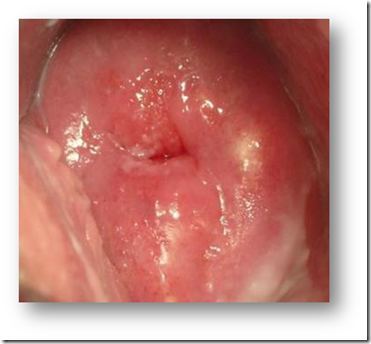 泌尿器科専門医 ドクター尾上の医療ブログ 性感染症について 女性