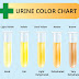 urine color chart what color is normal what does it mean - what does your urine colour mean brown wee could be a symptom of liver | liver failure urine color chart