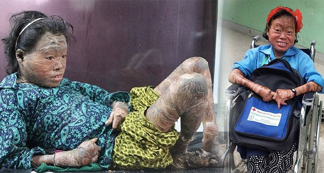 13歲女孩全身長滿 魚鱗癬 影響發育 直到醫生用 凡士林 裹滿全身改變了她的一生 Ez生活分享