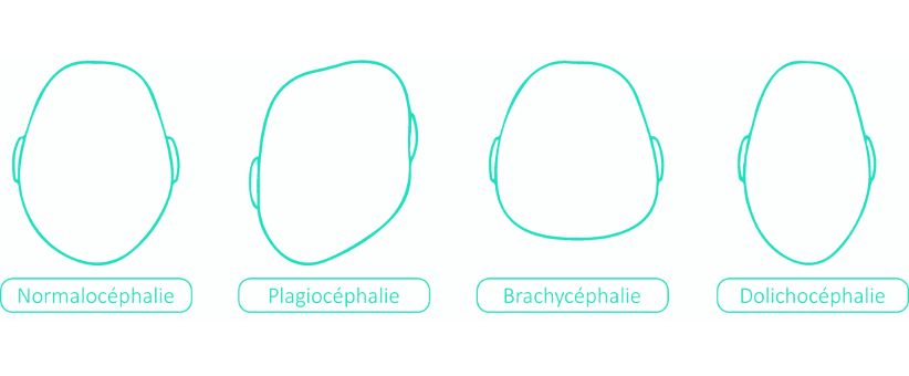 Bebe Et Plagiocephalie Mon Bebe A La Tete Plate Cabinet D Osteopathie De Retournac