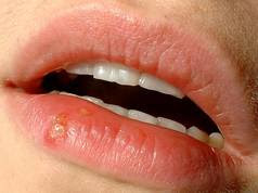 Coldsore